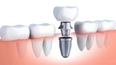 Why a Dental Implant Consultation is Crucial
